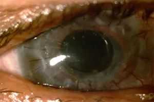 cornea2-300x200.webp