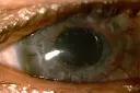 cornea2-300x200.webp